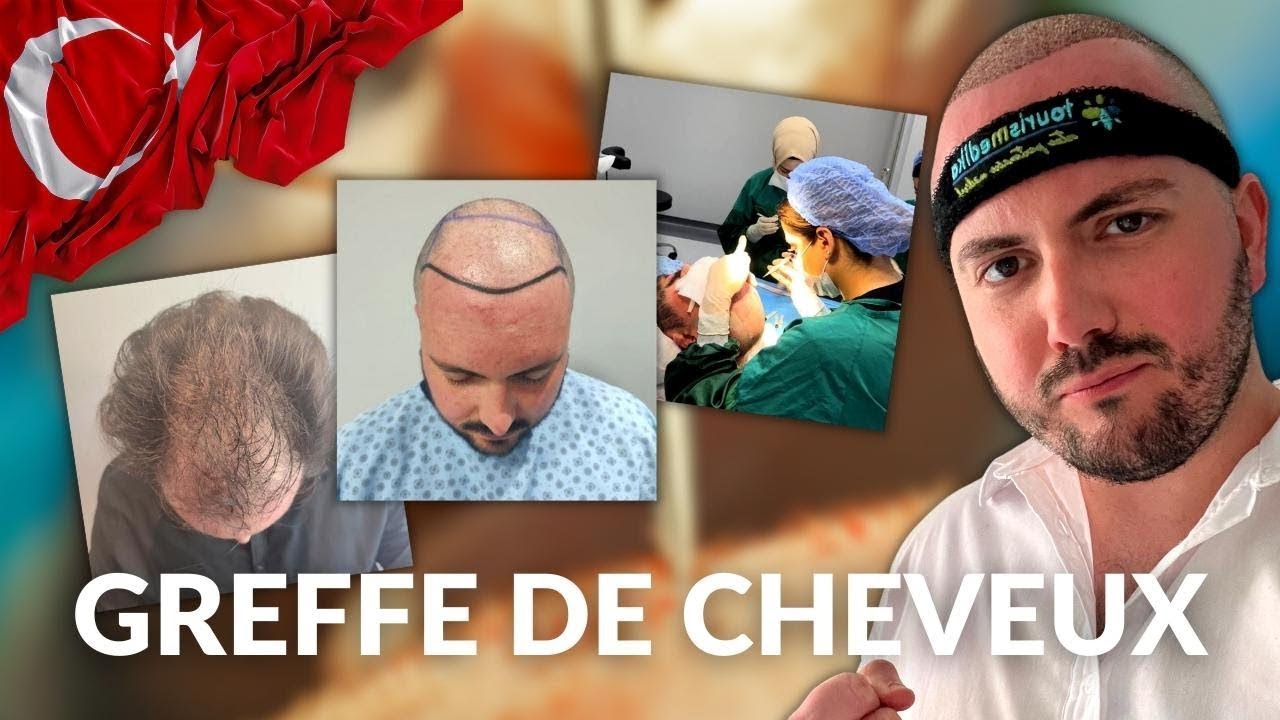 Greffe en Turquie : Je raconte Tout – Alexandre Chaimbault