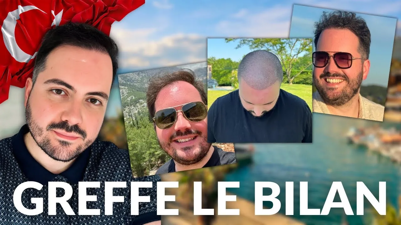 Évolution de la greffe de cheveux en Turquie au fil des mois